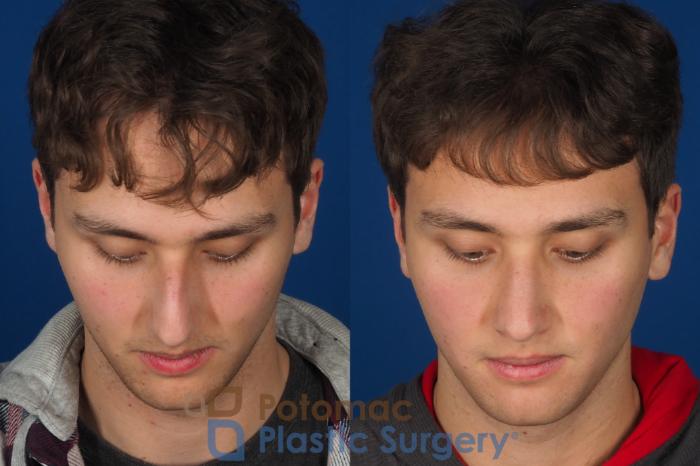 Before & After Rhinoplasty - Cosmetic Case 352 Top View in Washington DC & Arlington , DC