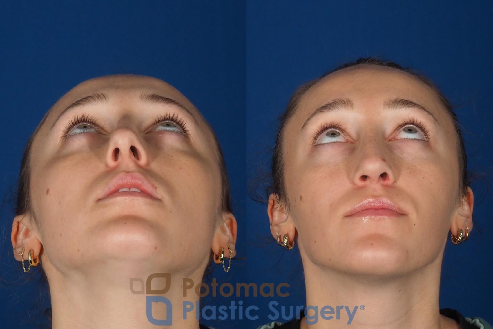 Before & After Rhinoplasty - Cosmetic Case 357 Bottom View in Washington DC & Arlington , DC