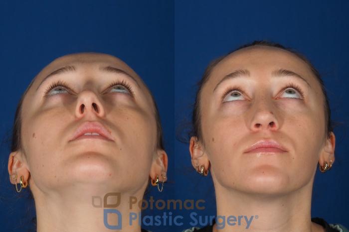 Before & After Rhinoplasty - Cosmetic Case 357 Bottom View in Washington DC & Arlington , DC
