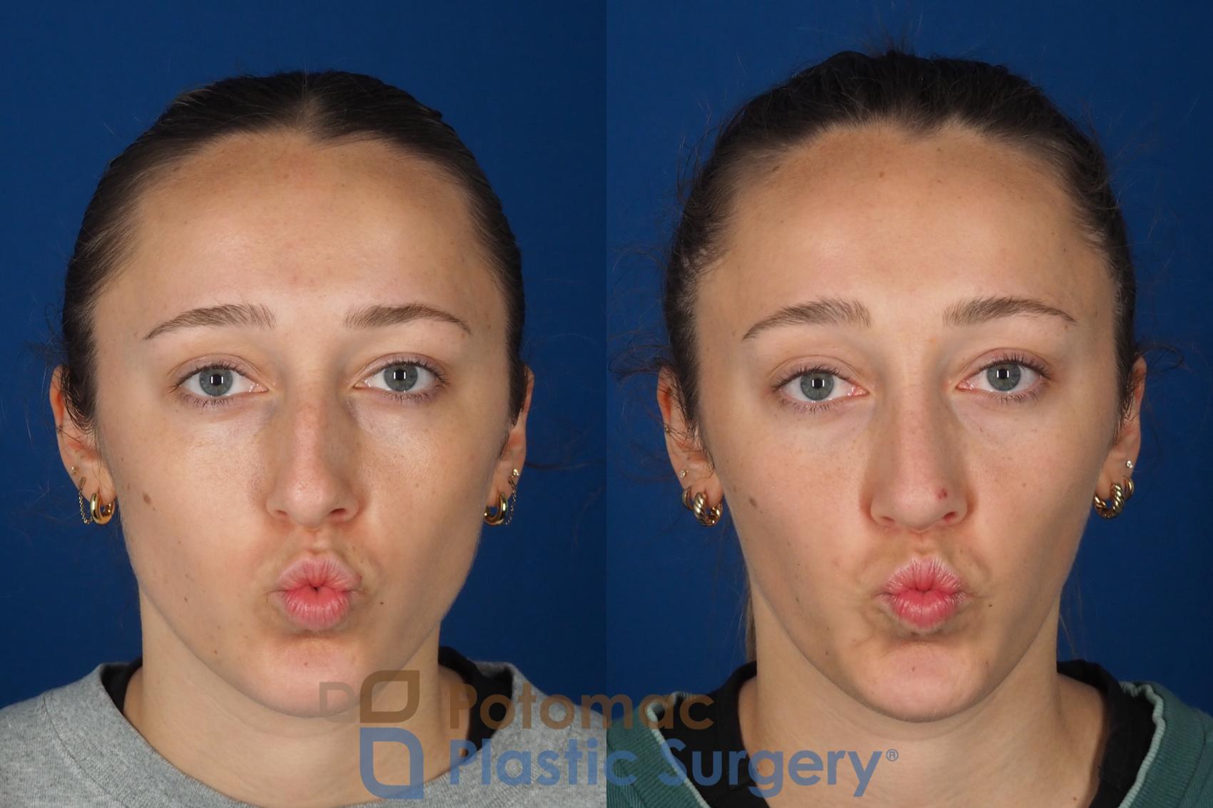 Before & After Rhinoplasty - Cosmetic Case 357 Front - Puckering View in Washington DC & Arlington , DC