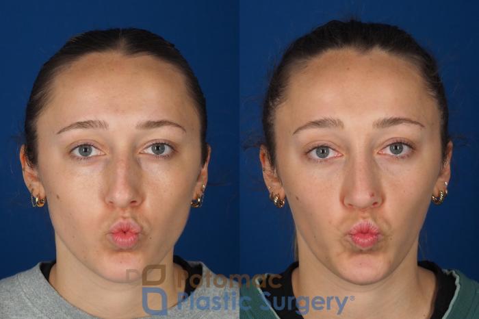 Before & After Rhinoplasty - Cosmetic Case 357 Front - Puckering View in Washington DC & Arlington , DC