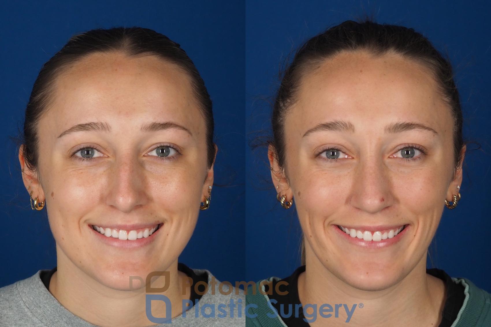 Before & After Rhinoplasty - Cosmetic Case 357 Front - Smiling View in Washington DC & Arlington , DC
