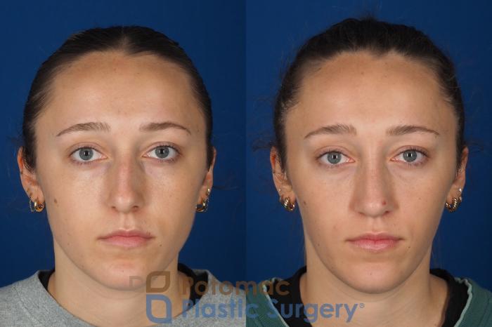 Before & After Rhinoplasty - Cosmetic Case 357 Front View in Washington DC & Arlington , DC
