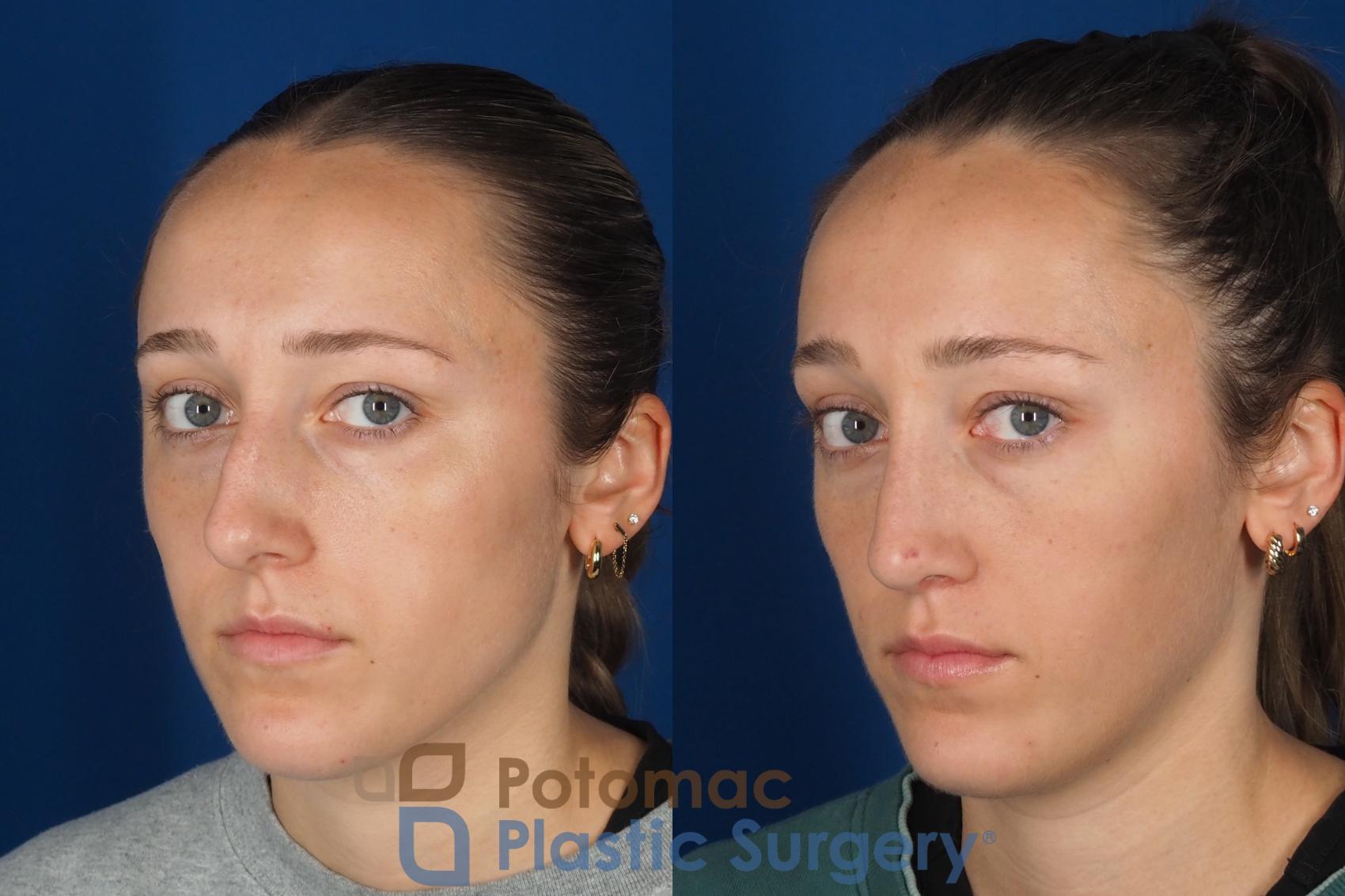 Before & After Rhinoplasty - Cosmetic Case 357 Left Oblique 2 View in Washington DC & Arlington , DC