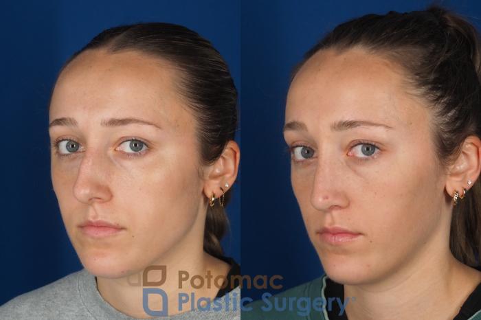 Before & After Rhinoplasty - Cosmetic Case 357 Left Oblique 2 View in Washington DC & Arlington , DC