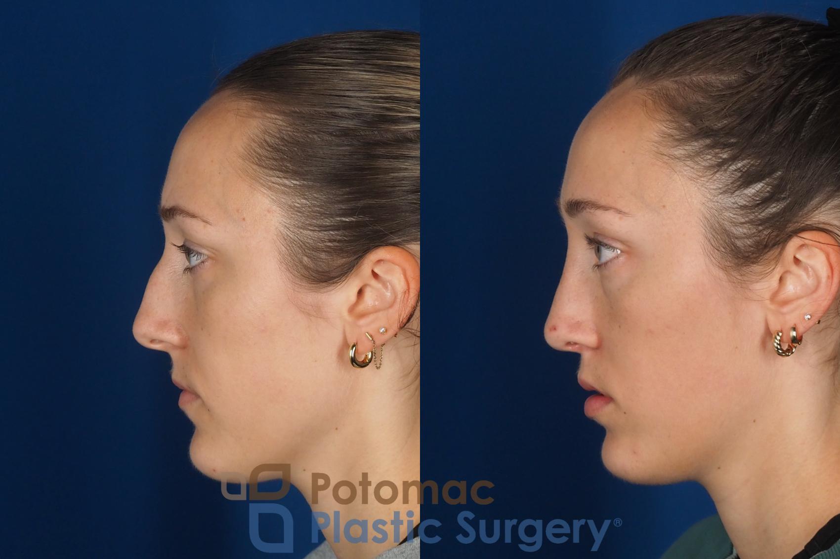 Before & After Rhinoplasty - Cosmetic Case 357 Left Side View in Washington DC & Arlington , DC