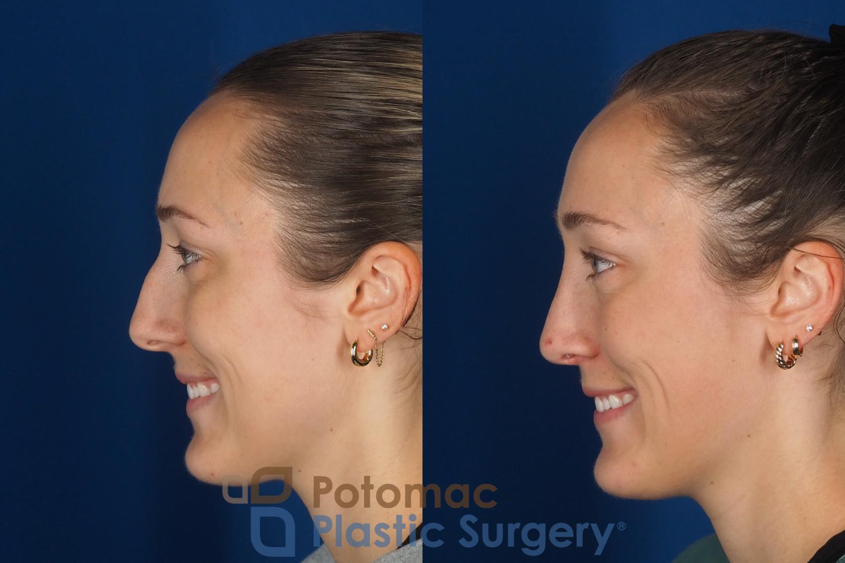 Before & After Rhinoplasty - Cosmetic Case 357 Left - Smiling View in Washington DC & Arlington , DC