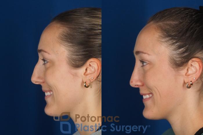 Before & After Rhinoplasty - Cosmetic Case 357 Left - Smiling View in Washington DC & Arlington , DC