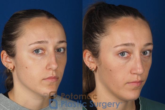 Before & After Rhinoplasty - Cosmetic Case 357 Right Oblique 2 View in Washington DC & Arlington , DC