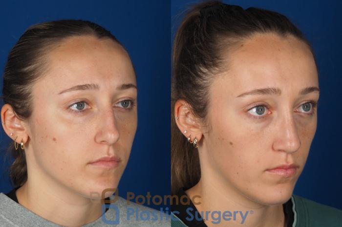 Before & After Rhinoplasty - Cosmetic Case 357 Right Oblique View in Washington DC & Arlington , DC