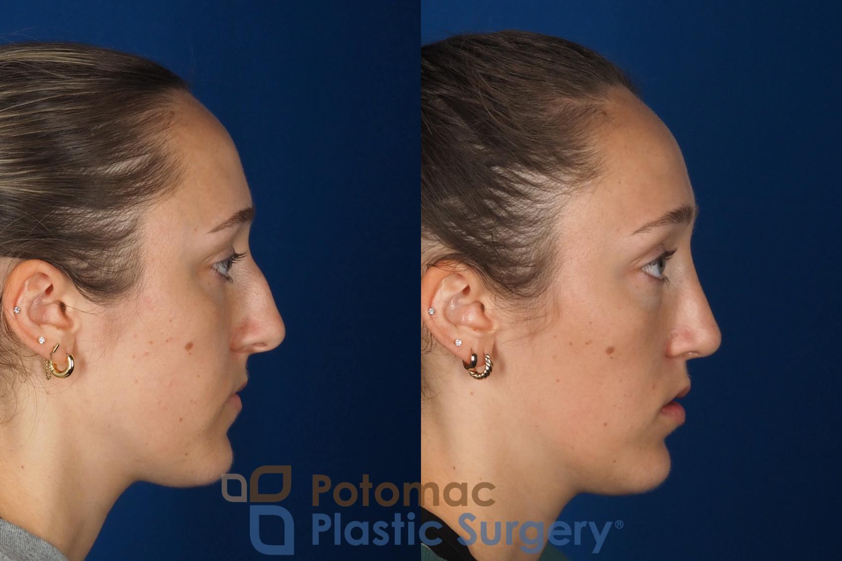 Before & After Rhinoplasty - Cosmetic Case 357 Right Side View in Washington DC & Arlington , DC