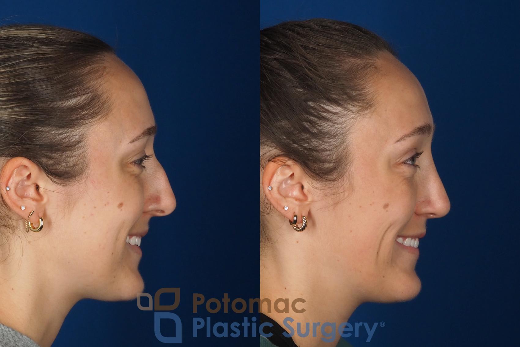 Before & After Rhinoplasty - Cosmetic Case 357 Right - Smiling View in Washington DC & Arlington , DC