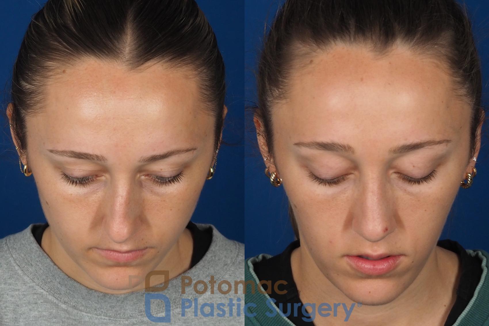 Before & After Rhinoplasty - Cosmetic Case 357 Top View in Washington DC & Arlington , DC
