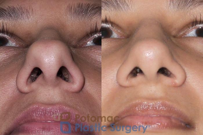 Before & After Rhinoplasty - Medical Case 36 Below View in Washington DC & Arlington , DC