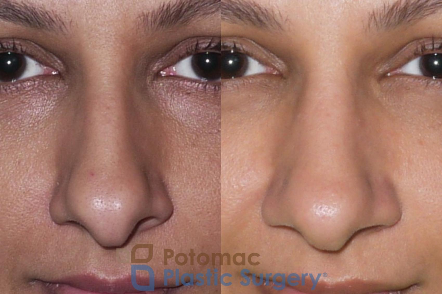 Before & After Rhinoplasty - Medical Case 36 Front View in Washington, DC