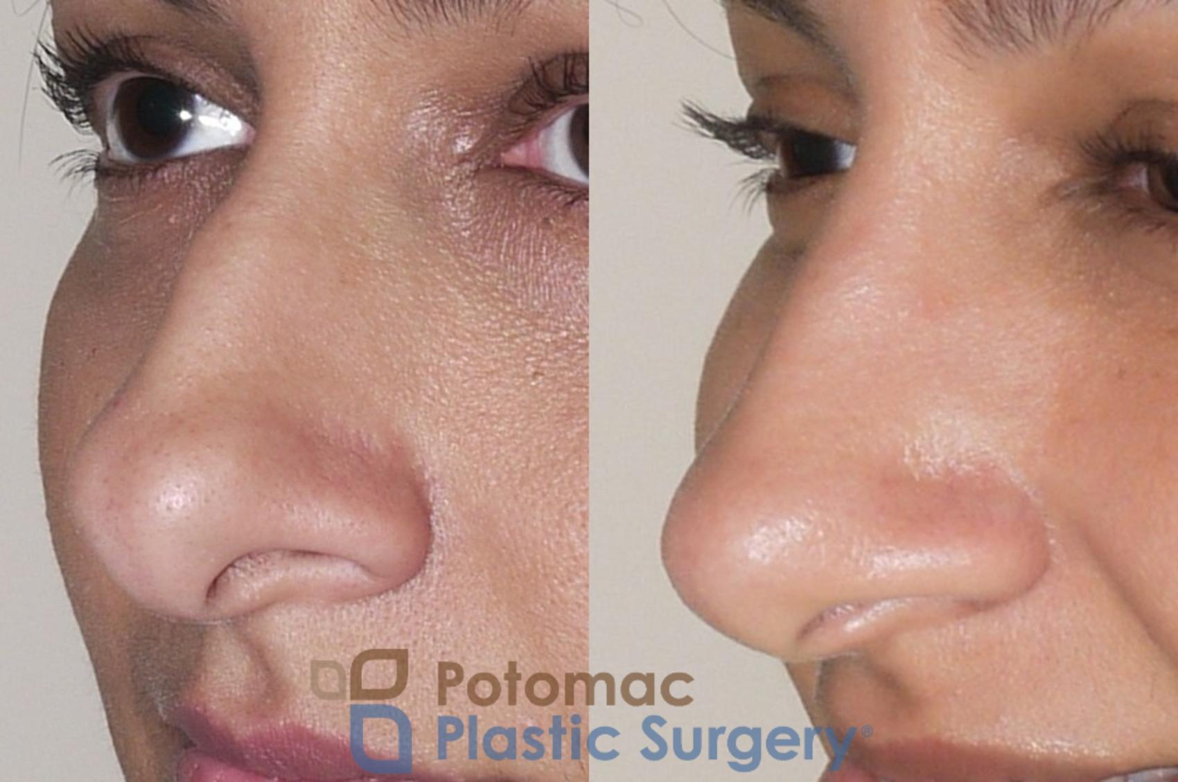 Before & After Rhinoplasty - Cosmetic Case 36 Left Oblique View in Washington DC & Arlington , DC