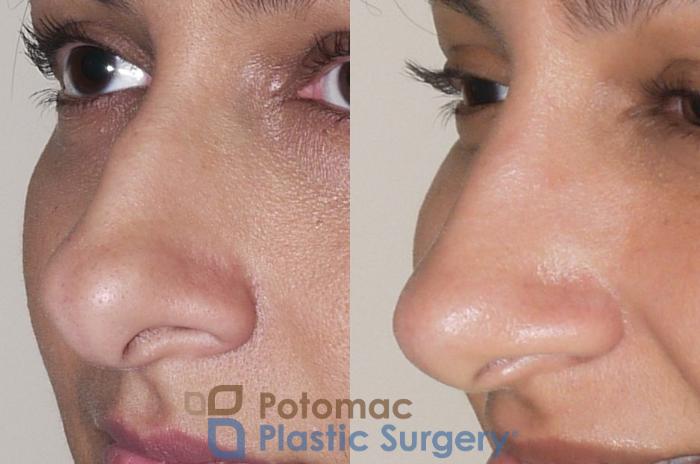 Before & After Rhinoplasty - Cosmetic Case 36 Left Oblique View in Washington, DC