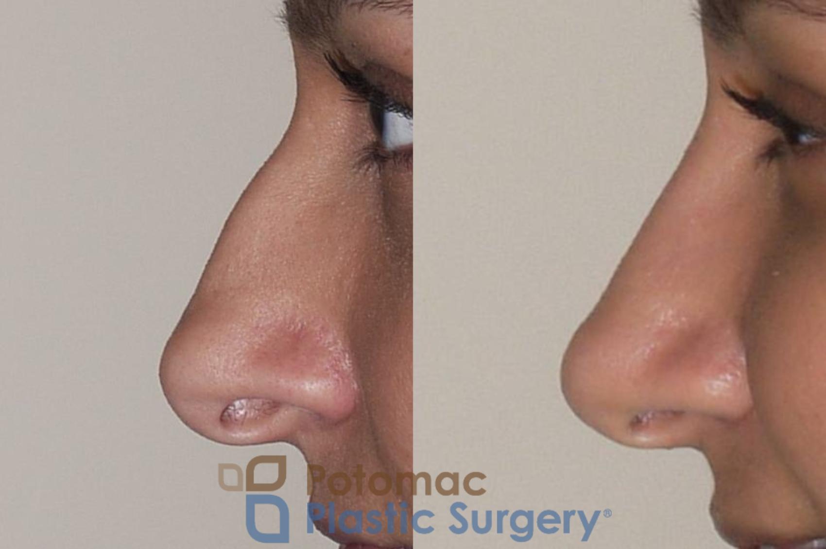 Before & After Rhinoplasty - Cosmetic Case 36 Left Side View in Washington DC & Arlington , DC