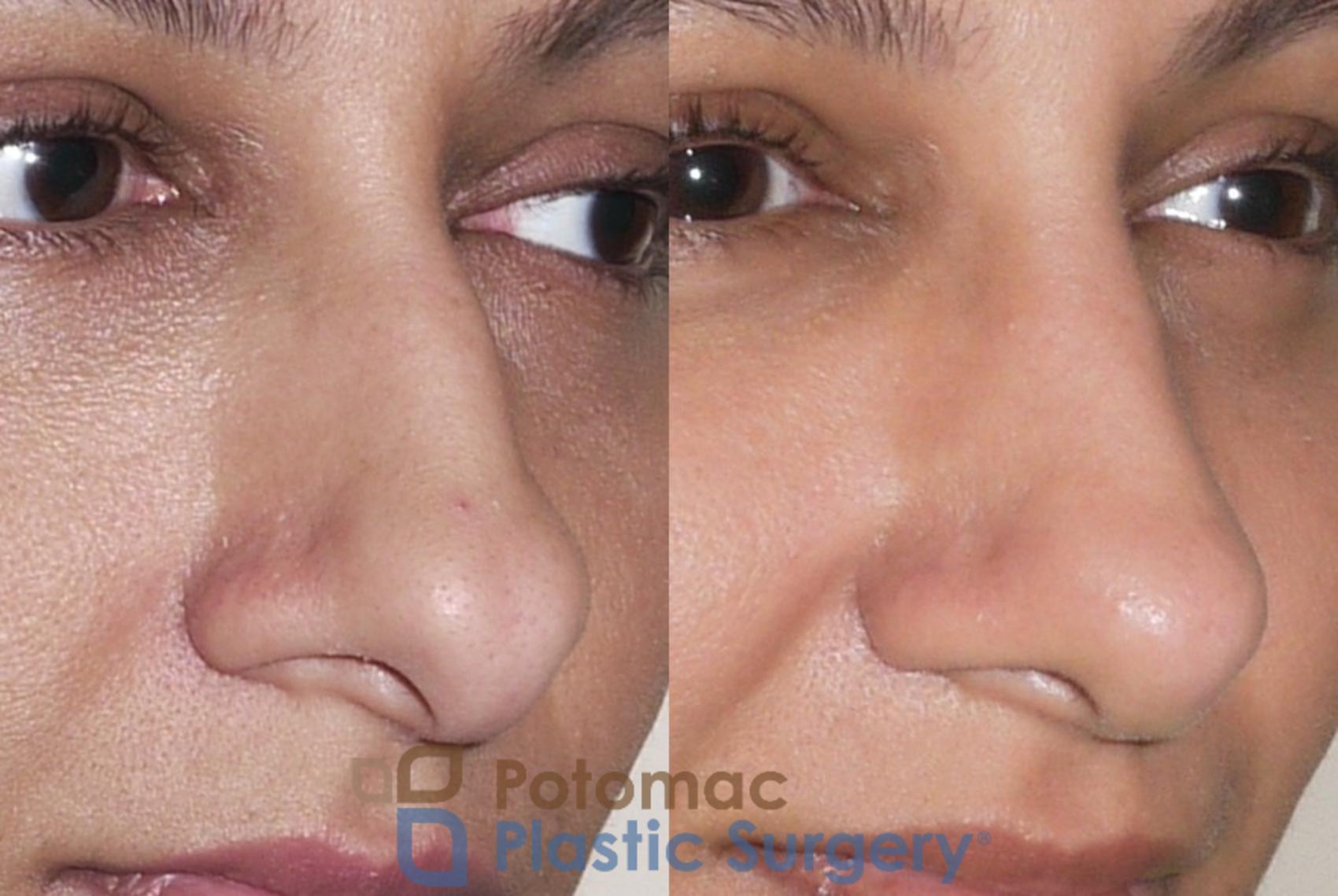 Before & After Rhinoplasty - Cosmetic Case 36 Right Oblique View in Washington DC & Arlington , DC