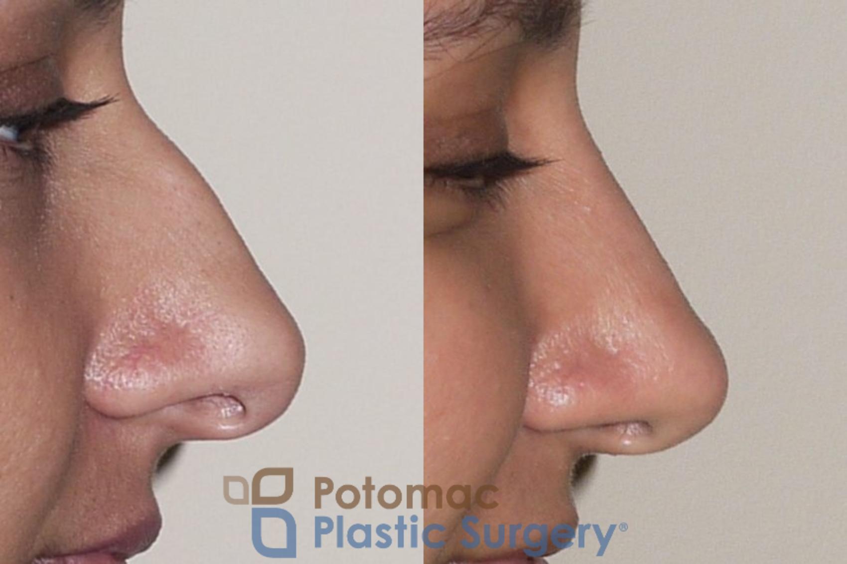 Before & After Rhinoplasty - Medical Case 36 Right Side View in Washington DC & Arlington , DC