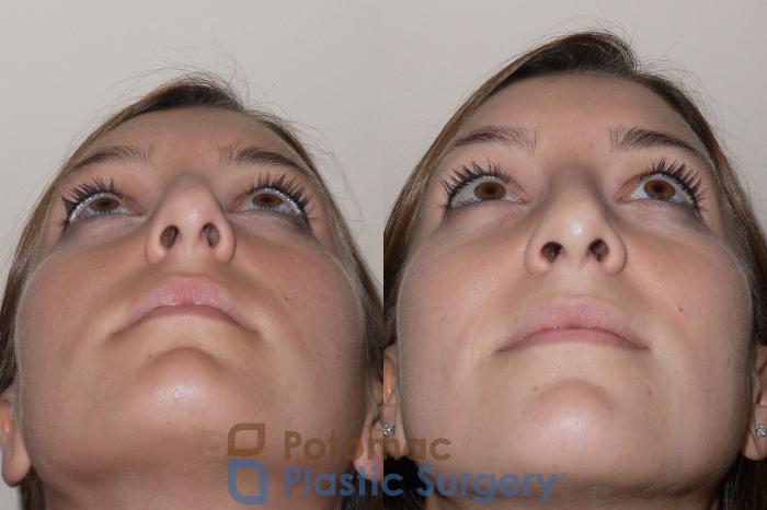 Before & After Rhinoplasty - Medical Case 39 Below View in Washington DC & Arlington , DC