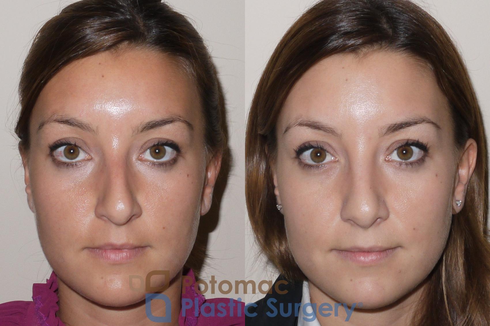 Before & After Rhinoplasty - Cosmetic Case 39 Front View in Washington, DC