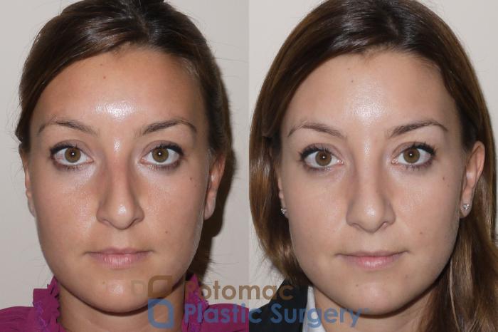 Before & After Rhinoplasty - Medical Case 39 Front View in Washington DC & Arlington , DC