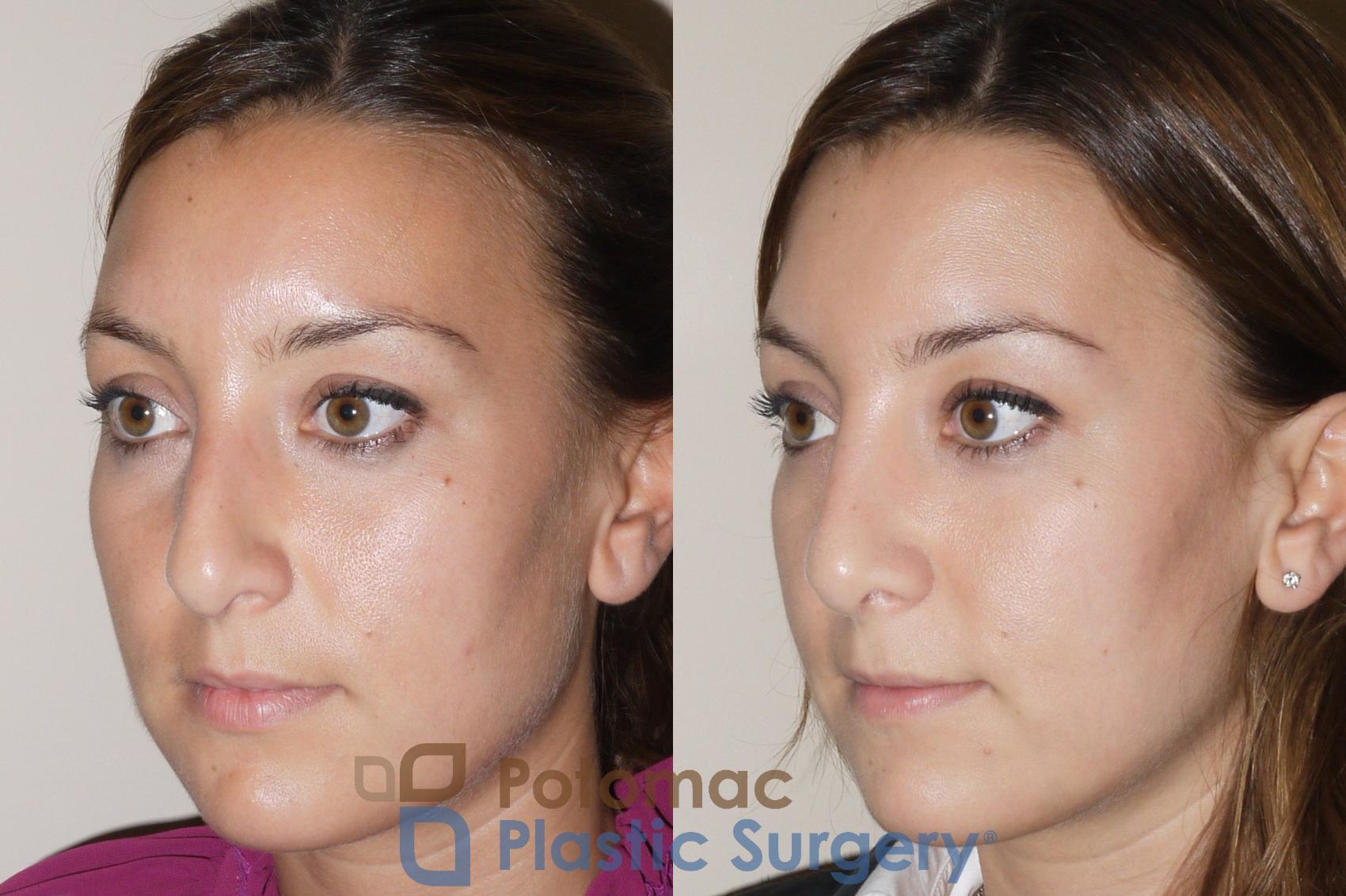 Before & After Rhinoplasty - Cosmetic Case 39 Left Oblique View in Washington, DC