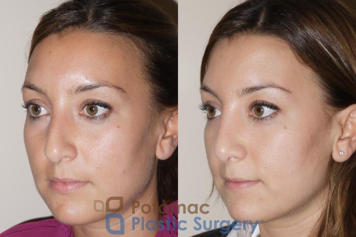 Before & After Rhinoplasty - Medical Case 39 Left Oblique View in Washington DC & Arlington , DC