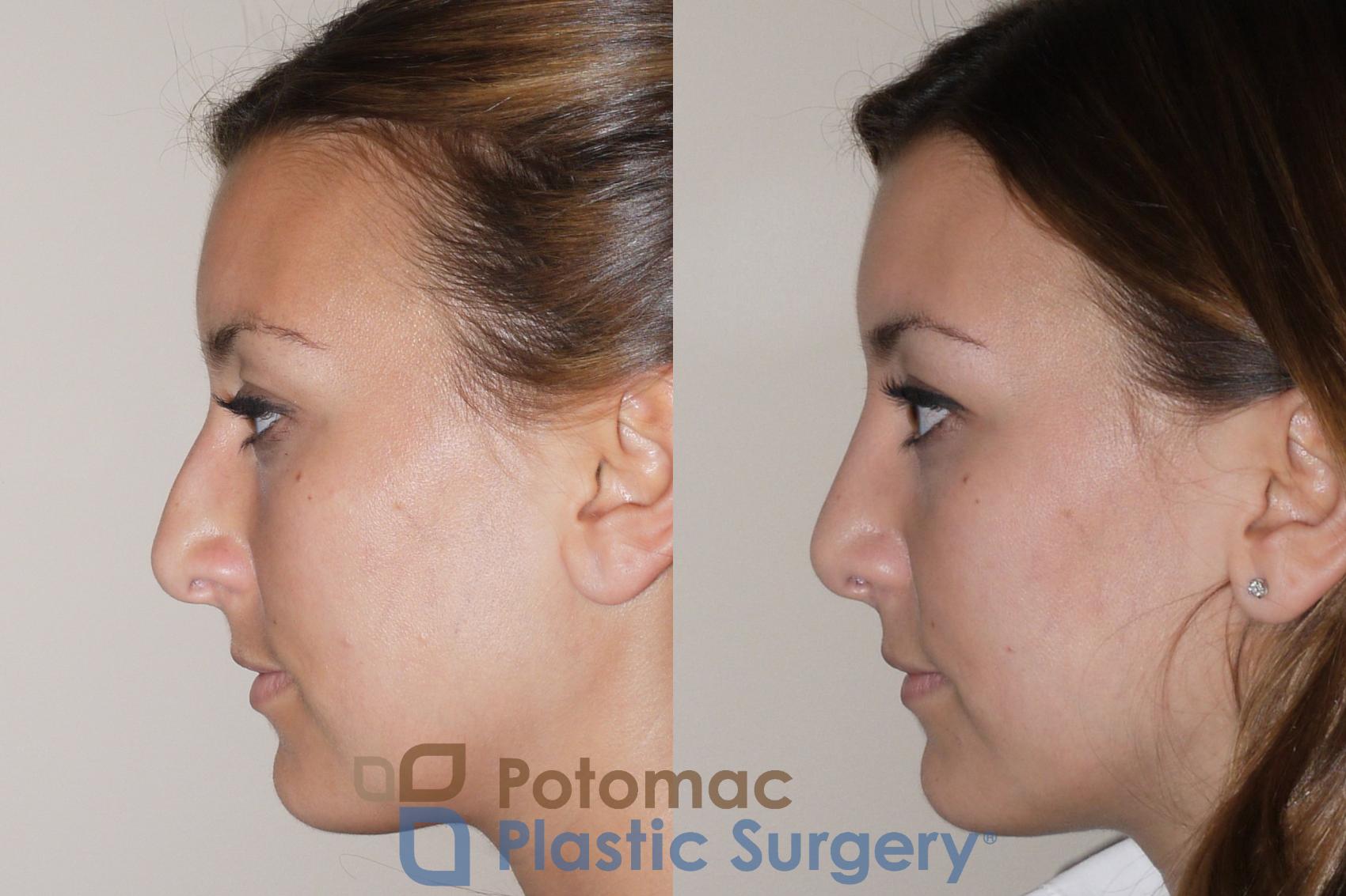 Before & After Rhinoplasty - Cosmetic Case 39 Left Side View in Washington, DC