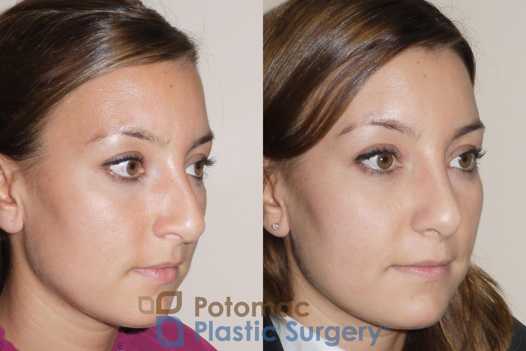 Before & After Rhinoplasty - Cosmetic Case 39 Right Oblique View in Washington DC & Arlington , DC