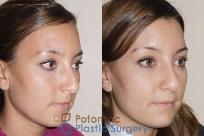 Before & After Rhinoplasty - Medical Case 39 Right Oblique View in Washington DC & Arlington , DC