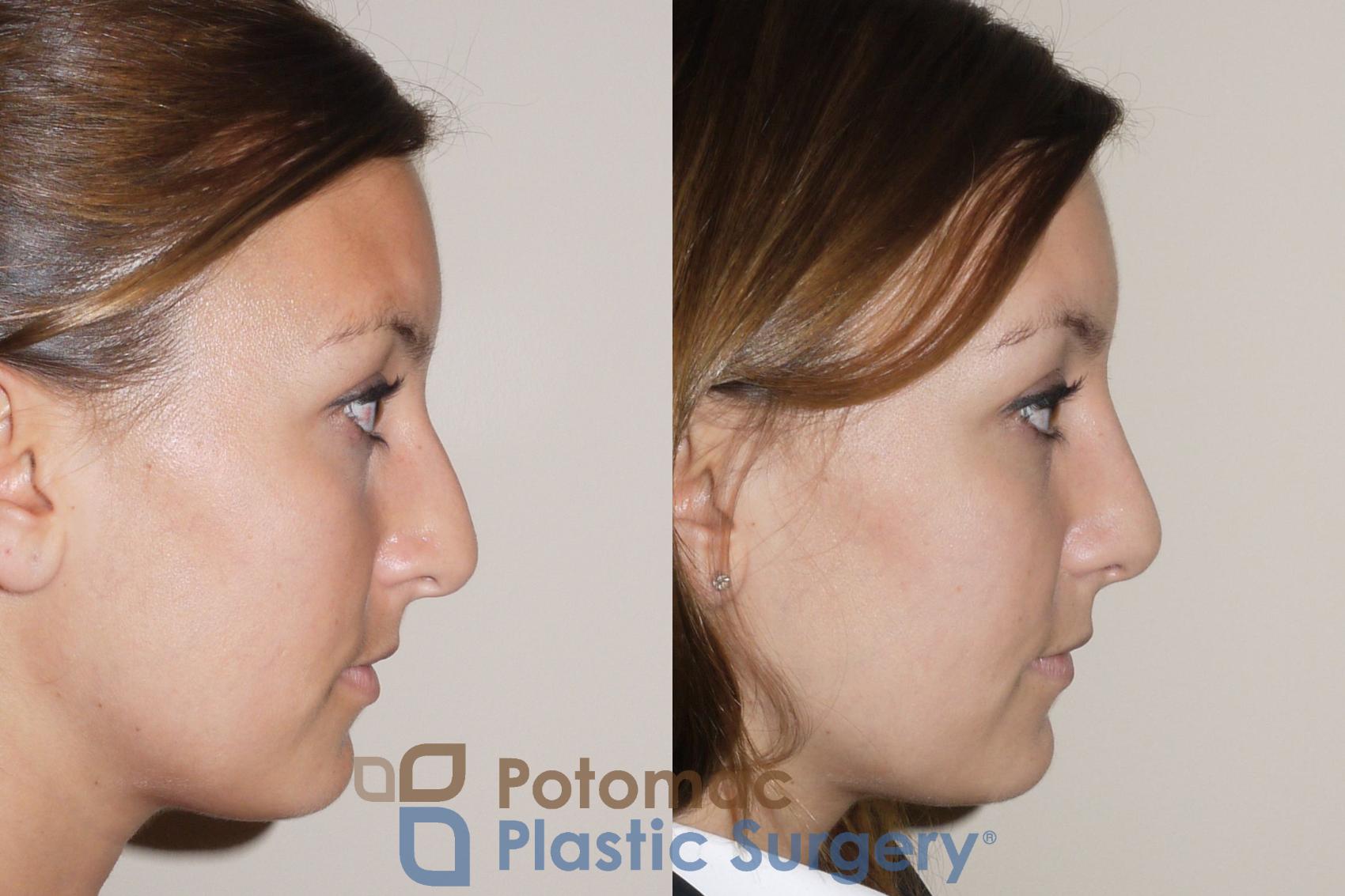 Before & After Rhinoplasty - Cosmetic Case 39 Right Side View in Washington, DC