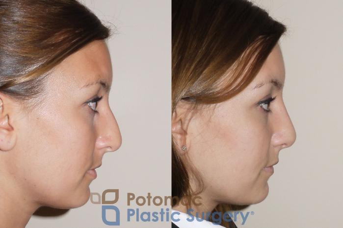Before & After Rhinoplasty - Medical Case 39 Right Side View in Washington DC & Arlington , DC