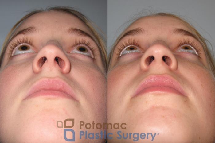 Before & After Rhinoplasty - Medical Case 4 Below View in Washington DC & Arlington , DC