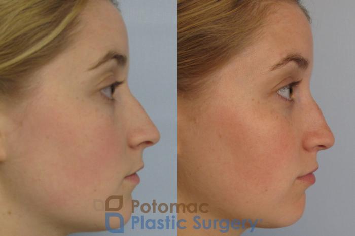 Before & After Rhinoplasty - Cosmetic Case 4 Right Side View in Washington DC & Arlington , DC