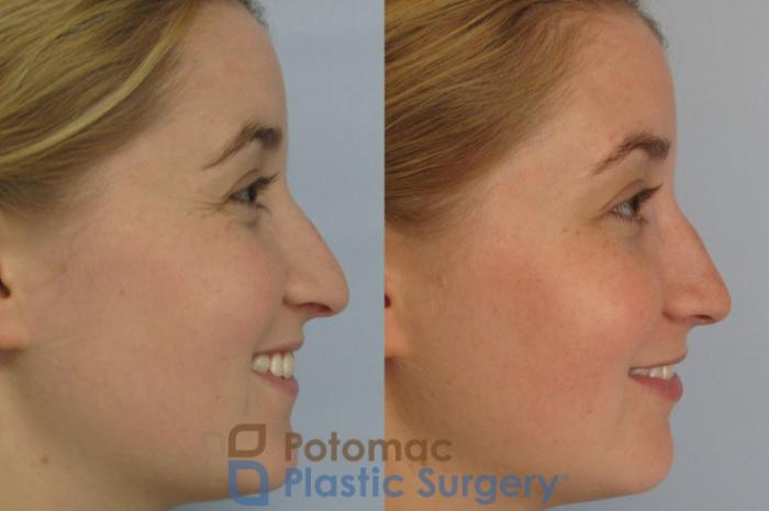 Before & After Rhinoplasty - Cosmetic Case 4 Right Side View #2 View in Washington DC & Arlington , DC