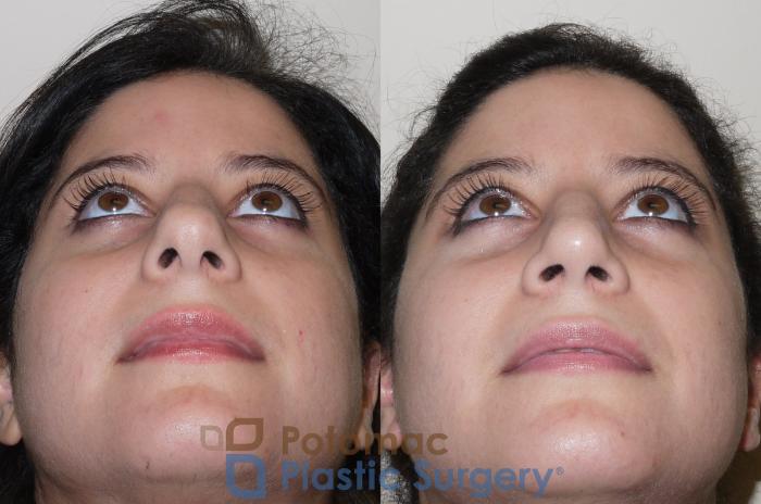 Before & After Rhinoplasty - Medical Case 42 Below View in Washington DC & Arlington , DC