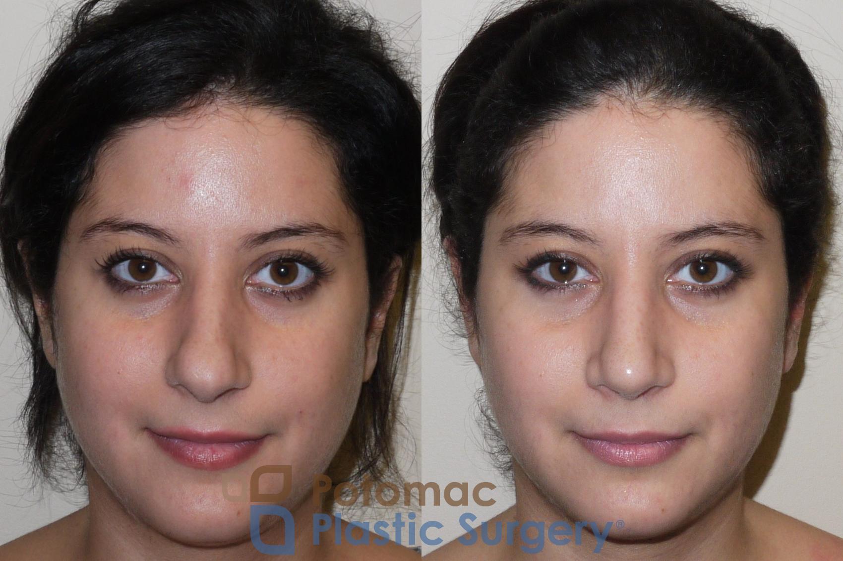 Before & After Rhinoplasty - Cosmetic Case 42 Front View in Washington, DC