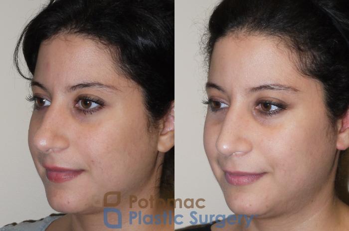 Before & After Rhinoplasty - Medical Case 42 Left Oblique View in Washington DC & Arlington , DC