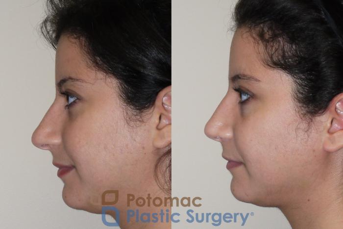 Before & After Rhinoplasty - Cosmetic Case 42 Left Side View in Washington DC & Arlington , DC