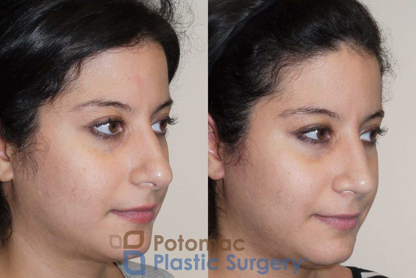 Before & After Rhinoplasty - Cosmetic Case 42 Right Oblique View in Washington DC & Arlington , DC