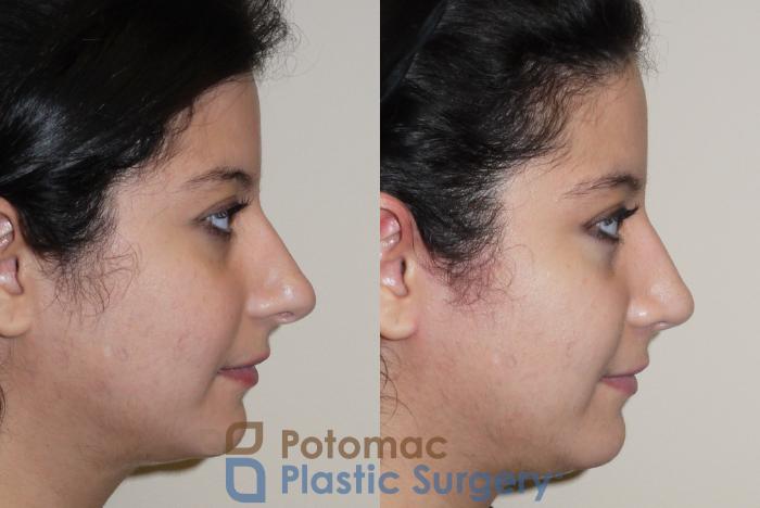 Before & After Rhinoplasty - Cosmetic Case 42 Right Side View in Washington DC & Arlington , DC