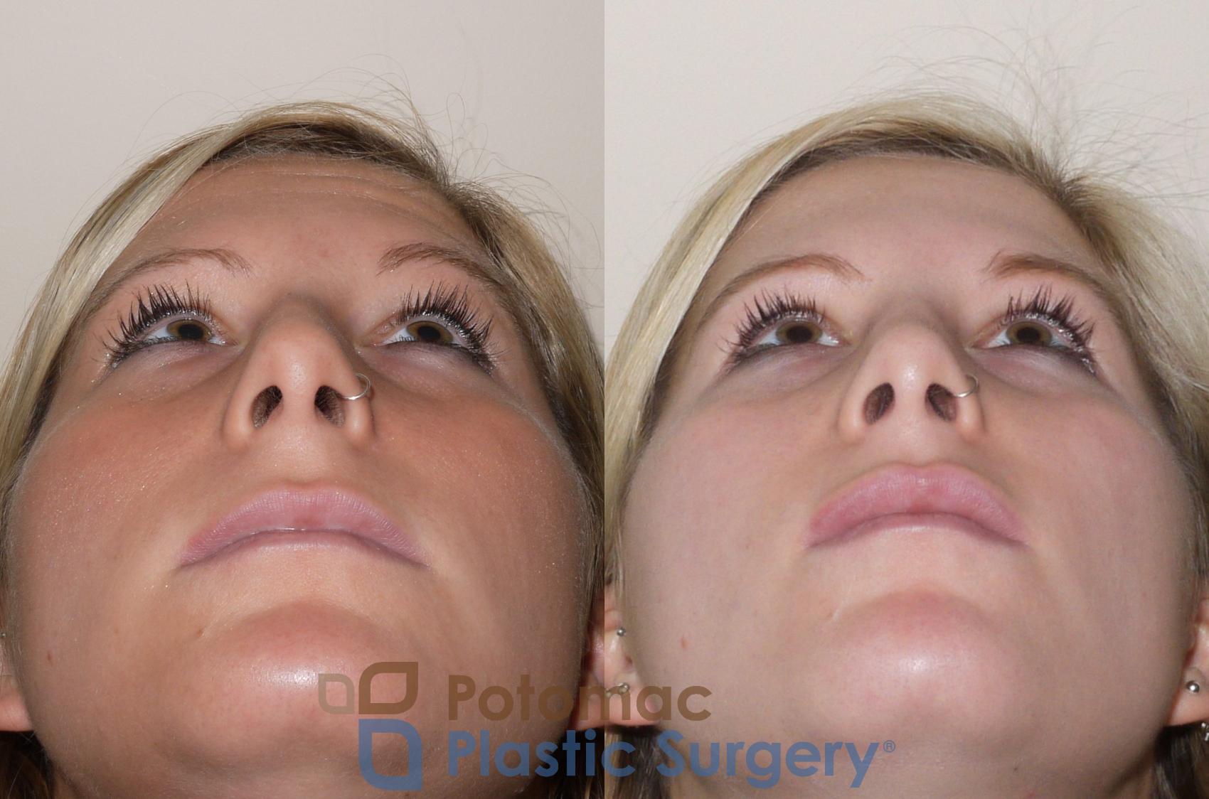 Before & After Rhinoplasty - Cosmetic Case 43 Bottom View in Washington DC & Arlington , DC