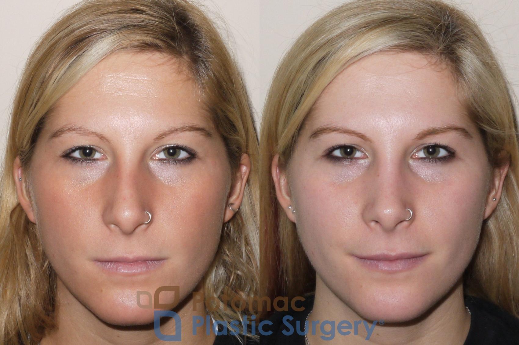 Before & After Dermal Fillers Case 43 Front View in Washington, DC