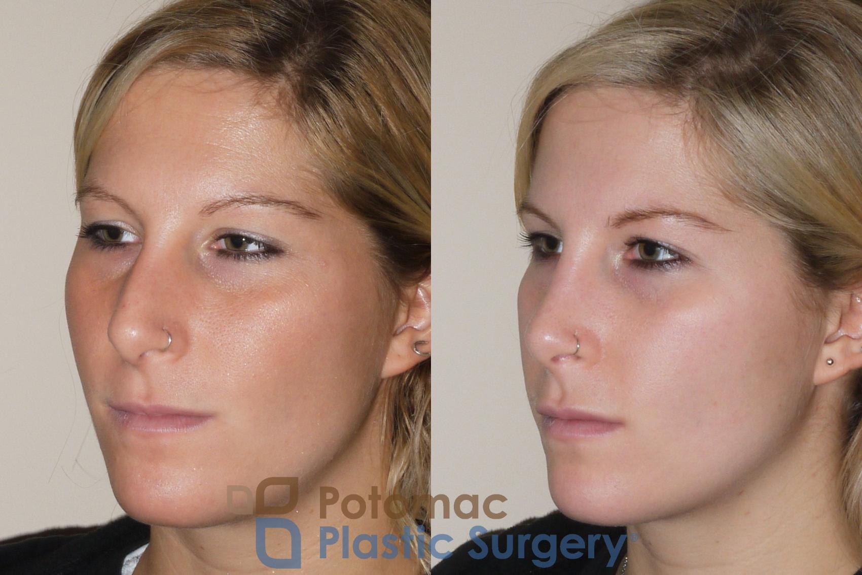 Before & After Rhinoplasty - Cosmetic Case 43 Left Oblique View in Washington DC & Arlington , DC