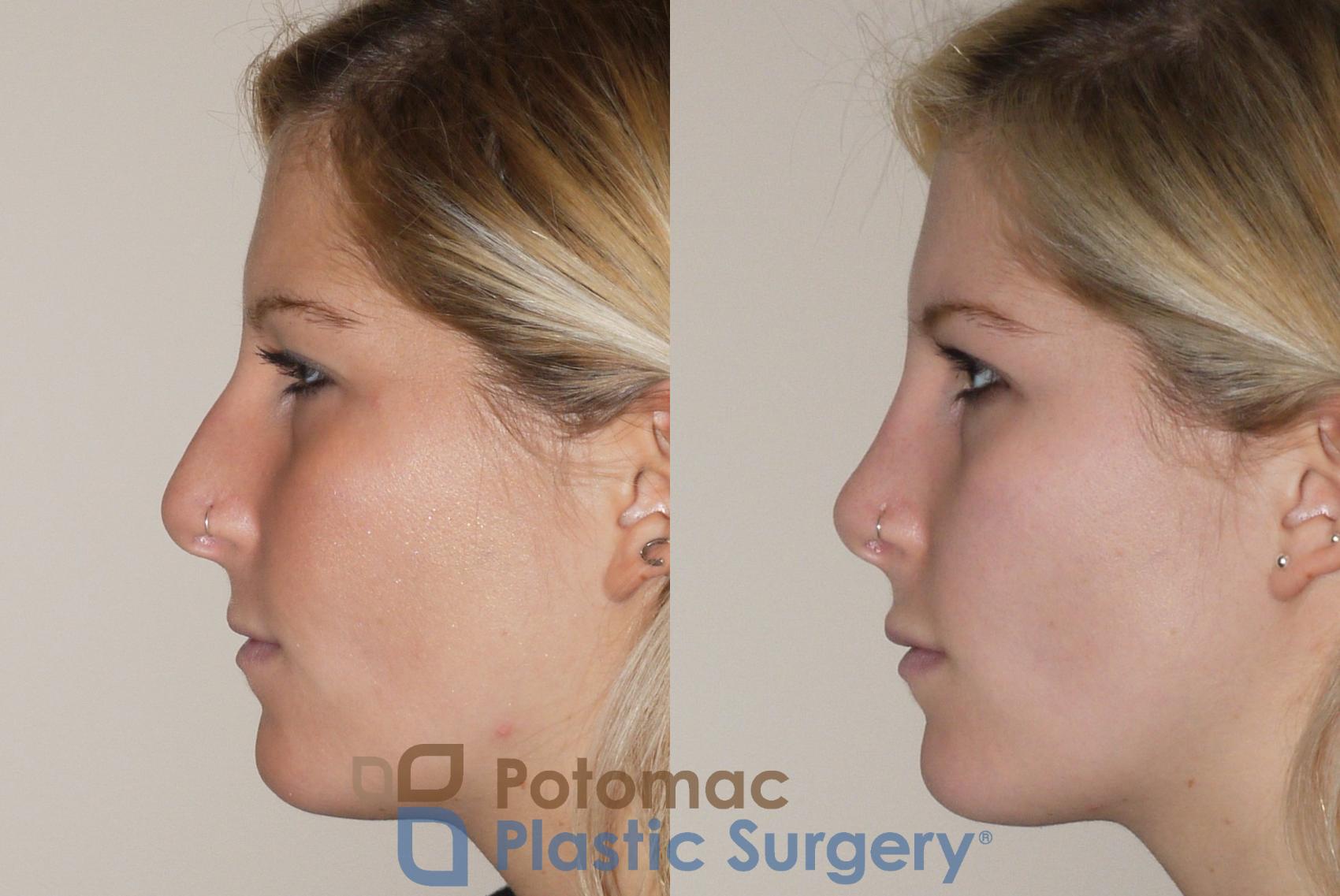 Before & After Rhinoplasty - Cosmetic Case 43 Left Side View in Washington DC & Arlington , DC
