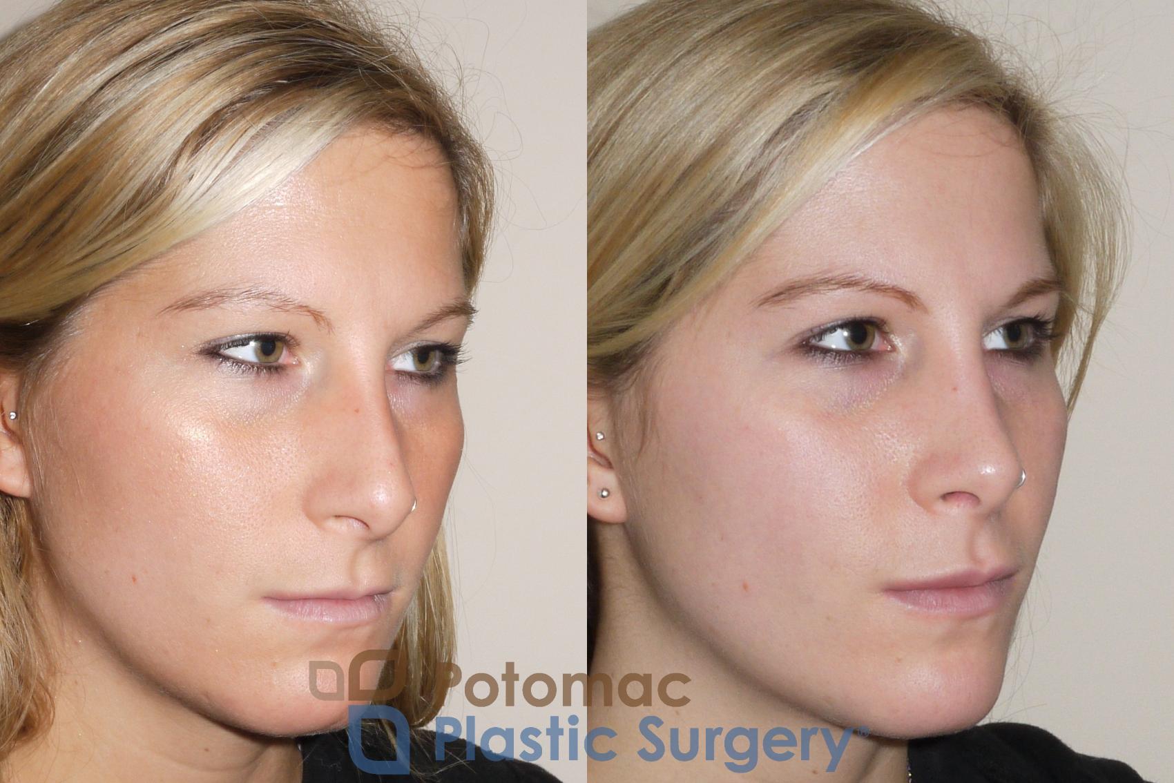 Before & After Rhinoplasty - Cosmetic Case 43 Right Oblique View in Washington DC & Arlington , DC