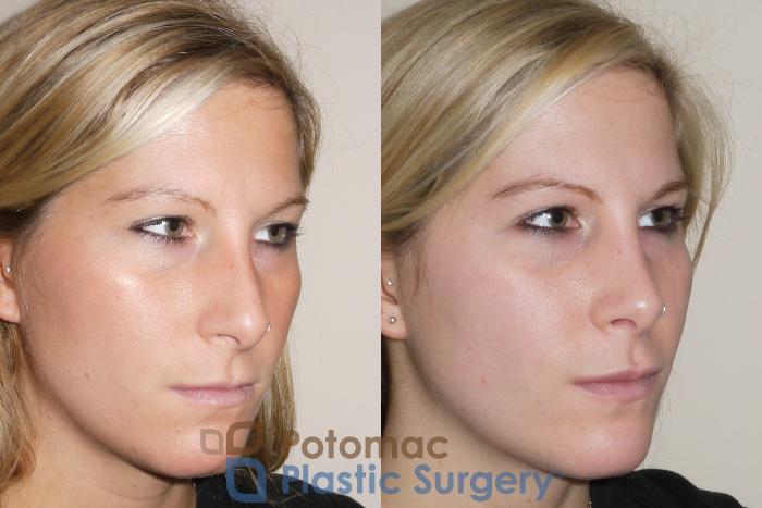 Before & After Dermal Fillers Case 43 Right Oblique View in Washington, DC