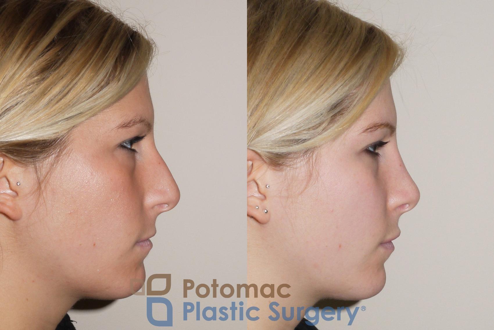 Before & After Dermal Fillers Case 43 Right Side View in Washington DC & Arlington , DC